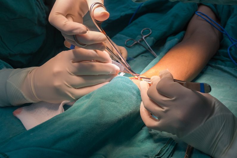 AV Fistula Surgery